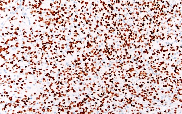 16E DMG (Case 16) Olig2 20X