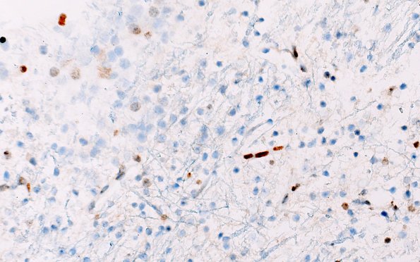 16G DMG (Case 16) H3K27MES3 40X 1