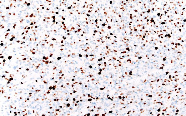 16H DMG (Case 16) Ki67 20X 1