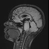 1A1 Difffuse Midline Glioma, H3K27 (Case 1) FLAIR