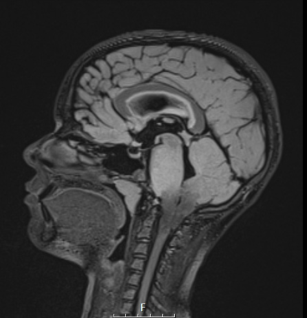 1A1 Difffuse Midline Glioma, H3K27 (Case 1) FLAIR