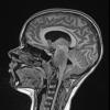 1A2 Difffuse Midline Glioma, H3K27 (Case 1) T1 noC SAG