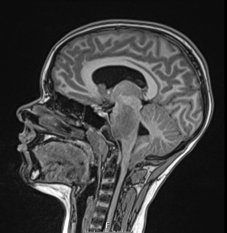 1A2 Difffuse Midline Glioma, H3K27 (Case 1) T1 noC SAG