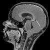 1A3 Difffuse Midline Glioma, H3K27 (Case 1) T1W SAG