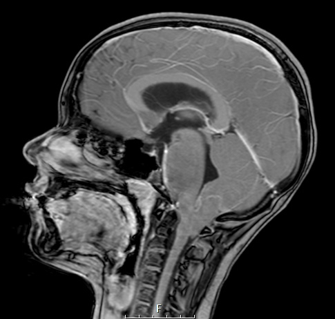 1A3 Difffuse Midline Glioma, H3K27 (Case 1) T1W SAG