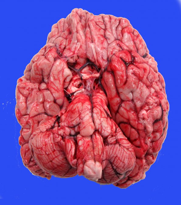 1B1 Difffuse Midline Glioma, H3K27 (Case 1) 1