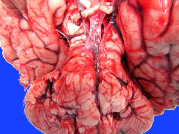 1B2 Difffuse Midline Glioma, H3K27 (Case 1) 3