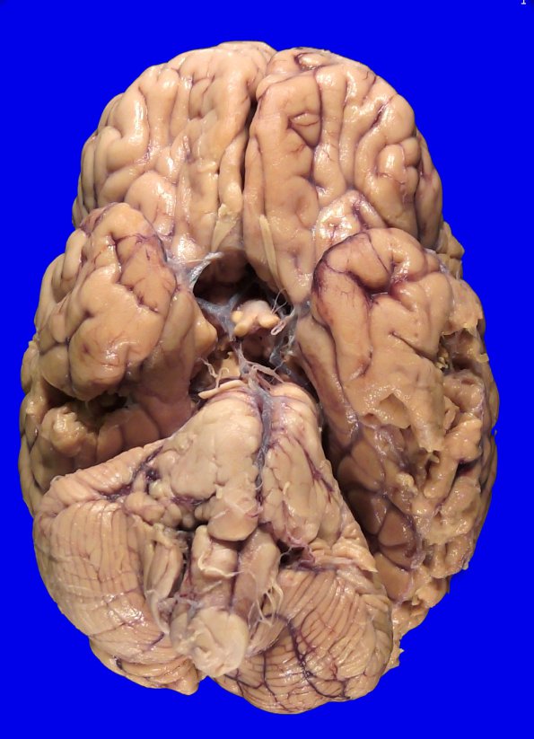 1C1 Glioma, Diffuse Infiltrating Pontine (DIPG, Case 1) _7