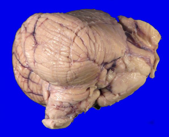 1C3 Glioma, Diffuse Infiltrating Pontine (DIPG, Case 1 _9