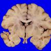 1C4 Glioma, Diffuse Infiltrating Pontine (DIPG, Case 1) _10