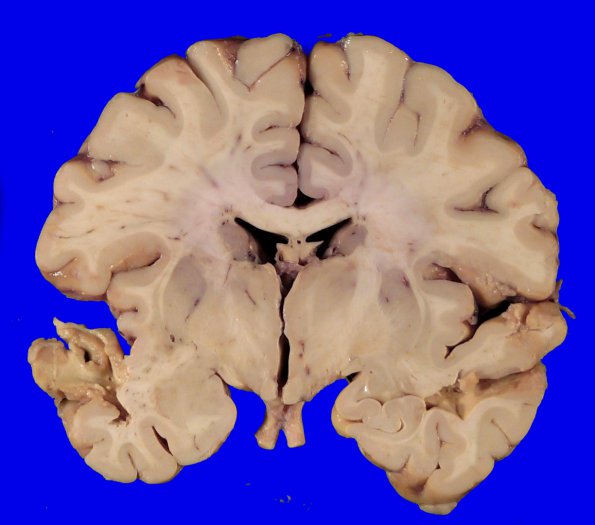 1C4 Glioma, Diffuse Infiltrating Pontine (DIPG, Case 1) _10