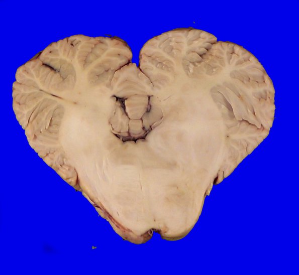 1C5 Glioma, Diffuse Infiltrating Pontine (DIPG, Case 1) _16