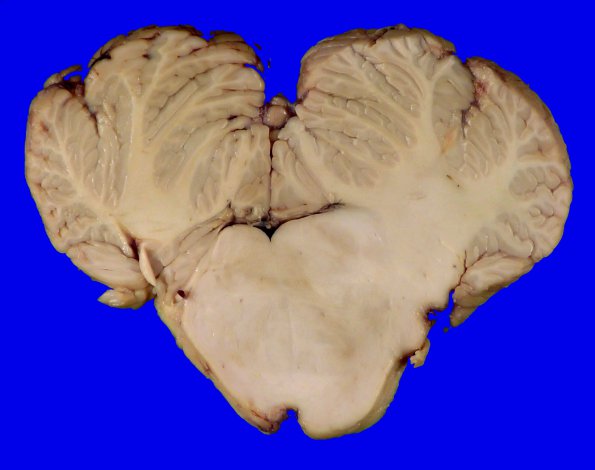 1C6 Glioma, Diffuse Infiltrating Pontine (DIPG, Case 1) _18