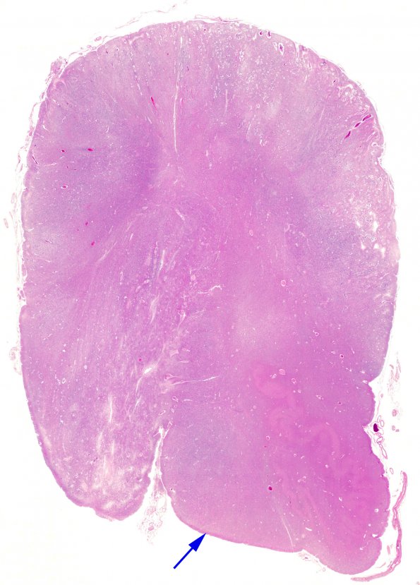 1D1 Difffuse Midline Glioma, H3K27 Glioma, (Case 1) N8 WM H&E copy