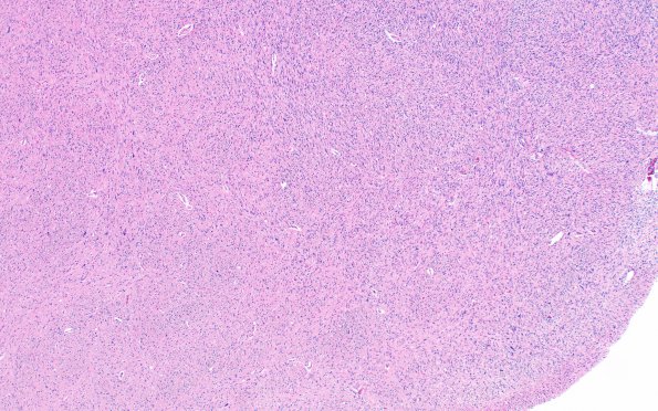 1D2 Glioma, Diffuse Infiltrating Pontine (DIPG, Case 1) N8 H&E 10X