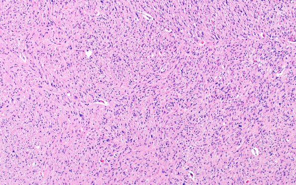 1D3 Glioma, Diffuse Infiltrating Pontine (DIPG, Case 1) N8 H&E 20X