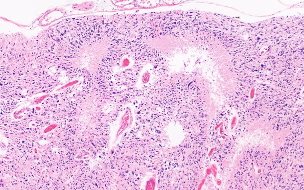 1D4 Glioma, Diffuse Infiltrating Pontine (DIPG, Case 1) N8 H&E 20X