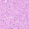 1D5 Glioma, Diffuse Infiltrating Pontine (DIPG, Case 1) N8 H&E 40X