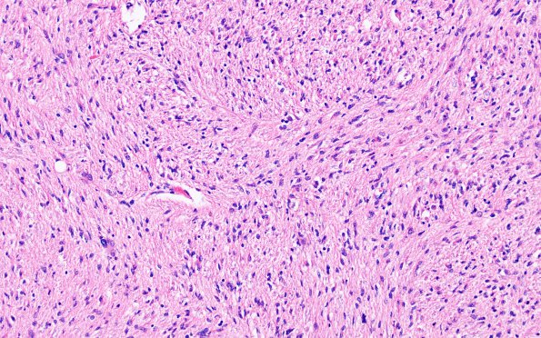 1D5 Glioma, Diffuse Infiltrating Pontine (DIPG, Case 1) N8 H&E 40X