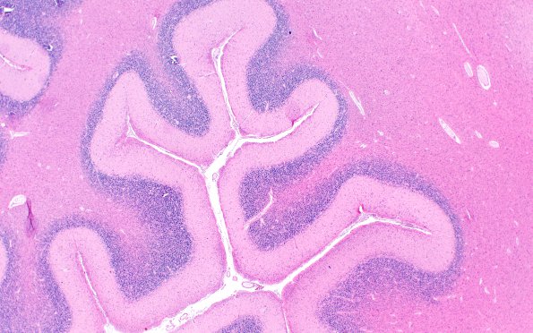 1D6 Glioma, Diffuse Infiltrating Pontine (DIPG, Case 1) N9 H&E 4X 2