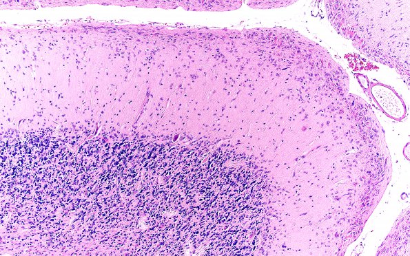 1D7 Glioma, Diffuse Infiltrating Pontine (DIPG, Case 1) N9 H&E 20X 2