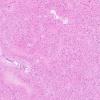 1D8 Glioma, Diffuse Infiltrating Pontine (DIPG, Case 1) N9 H&E $x