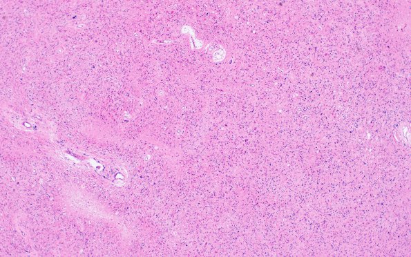 1D8 Glioma, Diffuse Infiltrating Pontine (DIPG, Case 1) N9 H&E $x