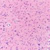 1D9 Glioma, Diffuse Infiltrating Pontine (DIPG, Case 1) N9 H&E 20X