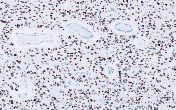 1E2 Glioma, Diffuse Infiltrating Pontine (DIPG, Case 1) H3K27M 20X