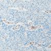 1F1 Glioma, Diffuse Infiltrating Pontine (DIPG, Case 1) H3K27me3 10X