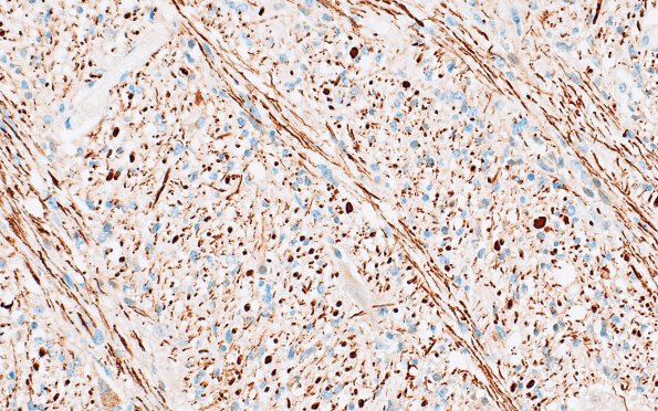 1G3 Glioma, Diffuse Infiltrating Pontine (DIPG, Case 1) NF 40X