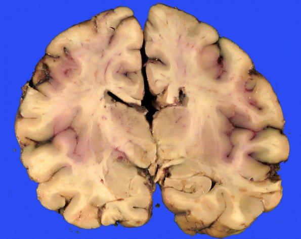 2B2 DIPG (Case 2) Gross _6