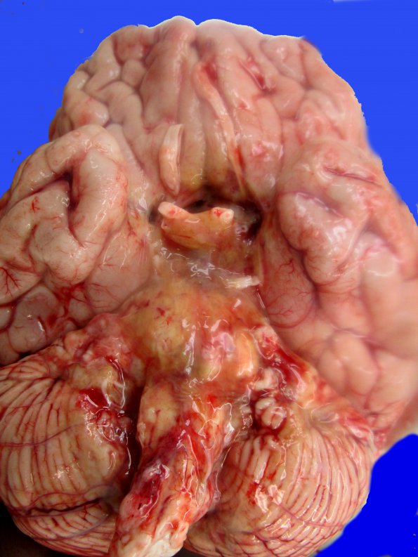 3A1 DMG, thalamus (Case 3) _5_3