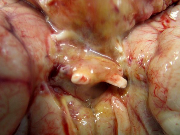 3A2 DMG, thalamus (Case 3) _5_1