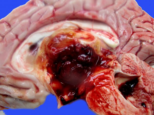 3A3 DMG, thalamus (Case 3) _4