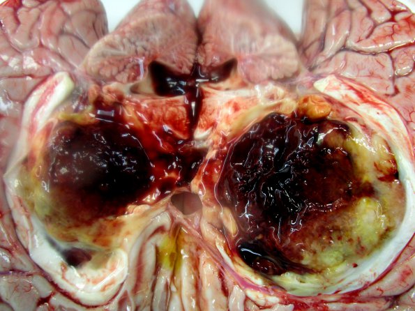 3A4 DMG, thalamus (Case 3) _2