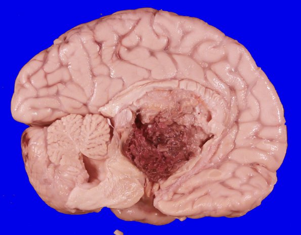 3A5 DMG, thalamus (Case 3) _5_7