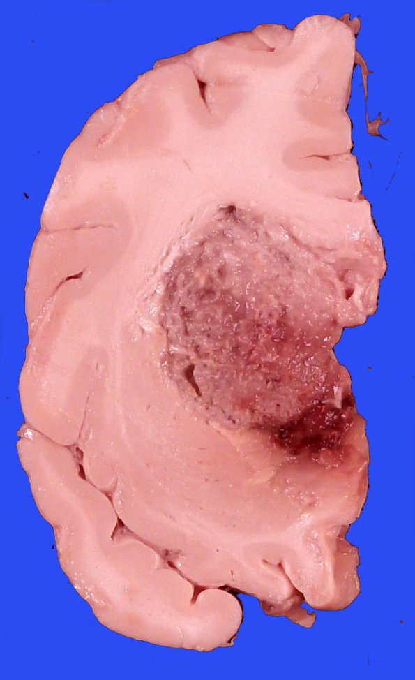 3A6 DMG, thalamus (Case 3) _5_11