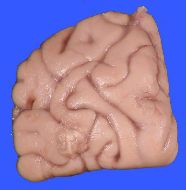 3A7 DMG, thalamus (Case 3) _5_17