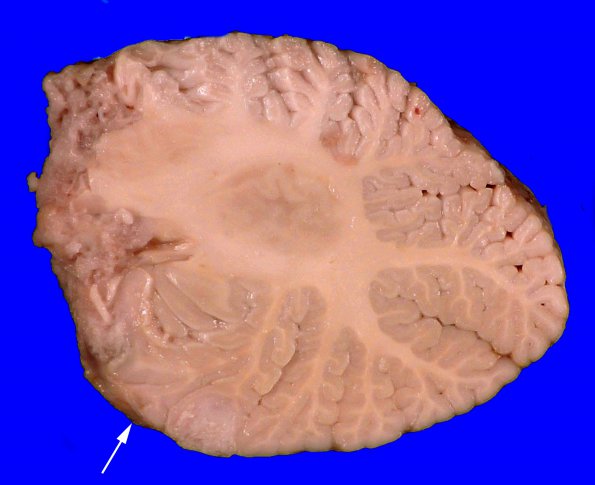 3A8 DMG, thalamus (Case 3) _5_23 copy