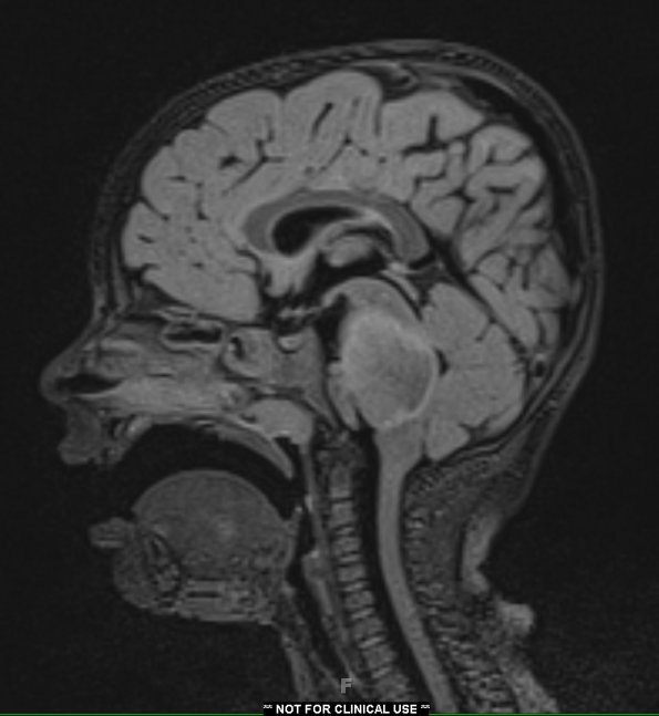 4A1 Diffuse midline glioma (DIPG) (Case 4) FLAIR 1