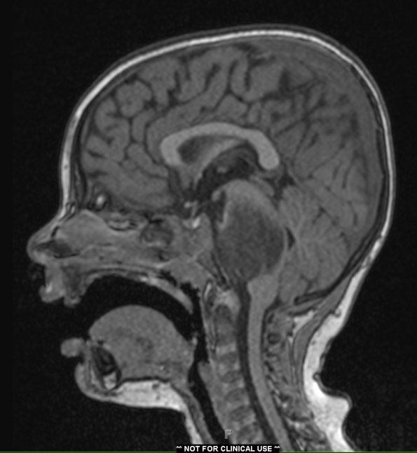 4A2 Diffuse midline glioma (DIPG) (Case 4) T1 W