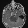 4A3 Diffuse midline glioma (DIPG) (Case 4) T1 W