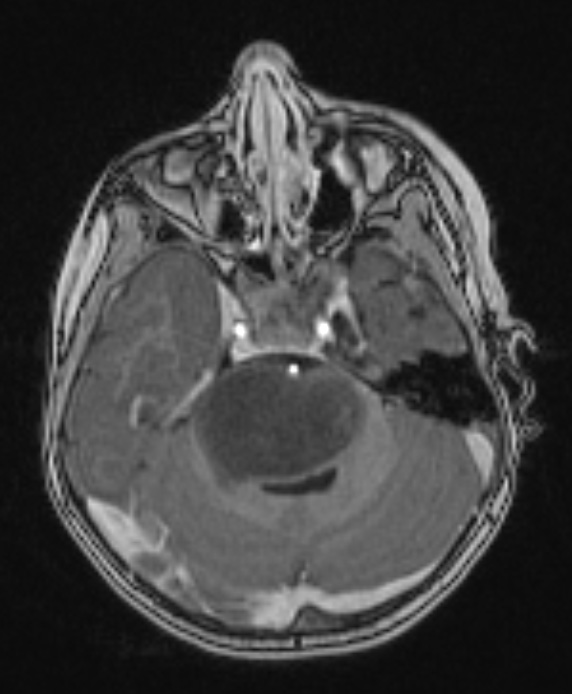 4A3 Diffuse midline glioma (DIPG) (Case 4) T1 W