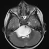 4A4 Diffuse midline glioma (DIPG) (Case 4) T2noC