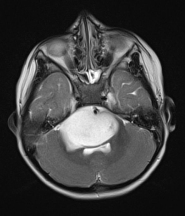 4A4 Diffuse midline glioma (DIPG) (Case 4) T2noC