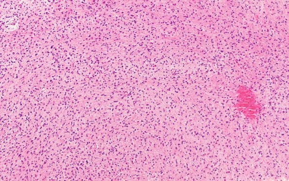 4B1 Diffuse midline glioma, (Case 4) H&E 1