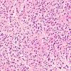 4B2 Diffuse midline glioma, (Case 4) H&E 7