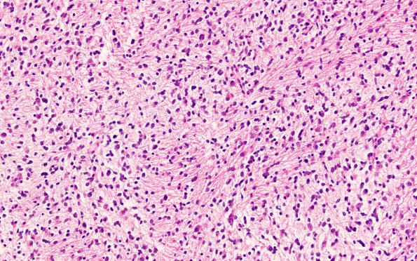 4B2 Diffuse midline glioma, (Case 4) H&E 7