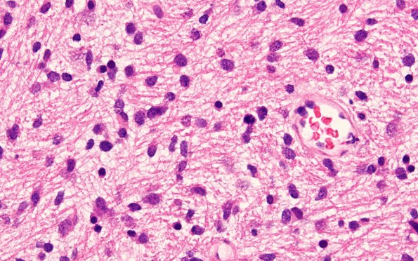 4B3 Diffuse midline glioma, (Case 4) H&E 3